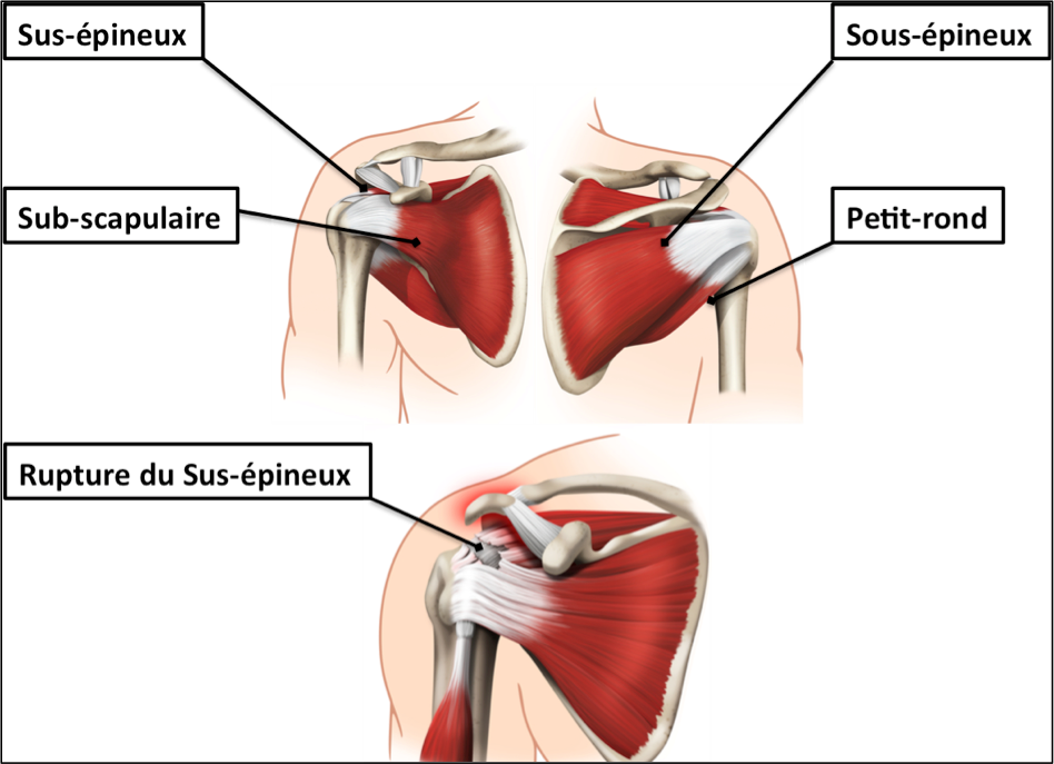 La Coiffe Des Rotateurs Par Le Dr Stéphane Vasseur Montpellier Orthopole 34 3569