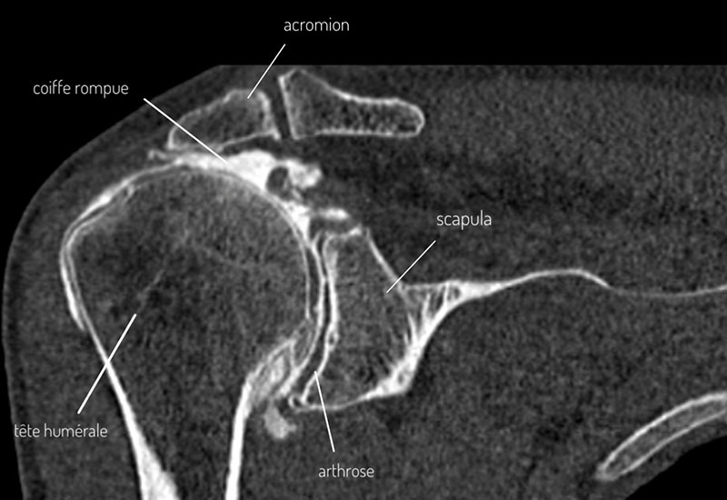 scanner-arthrose-epaule scanner-arthrose-epaule